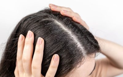 The woman holds her head with her hands, showing a parting of dark hair with dandruff. Close up. The view from the top. White background. The concept of dandruff and pediculosis.